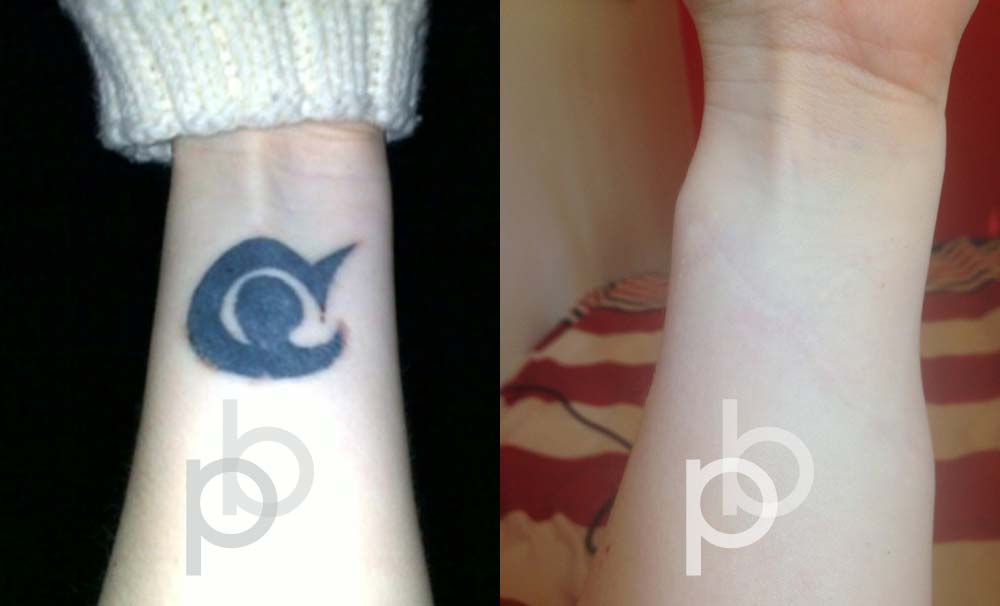 Paul Banweel tattoo removal-140619