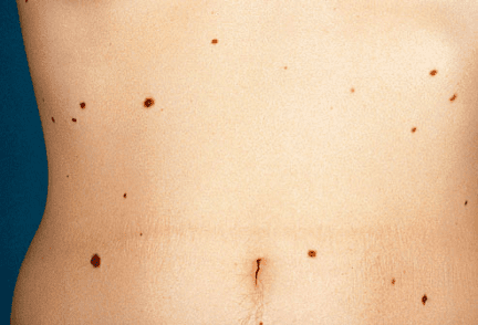 Sunbed|Actinic keratosis||||Carcinoma|Basal Cell Carcinoma||Melanoma|Asymetric mole||Colours in mole||||Suncreen