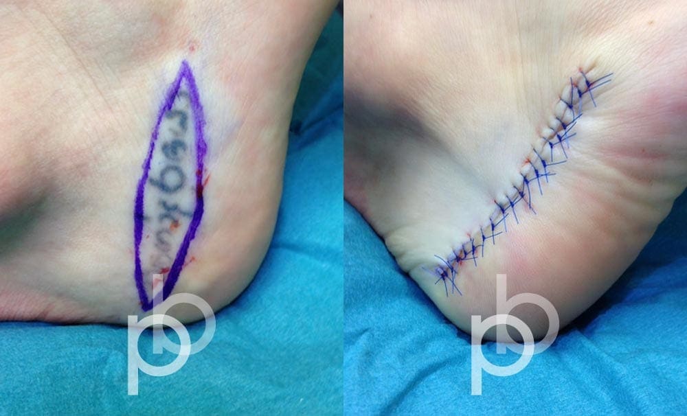 Paul-Banwell-tattoo-excision-090321