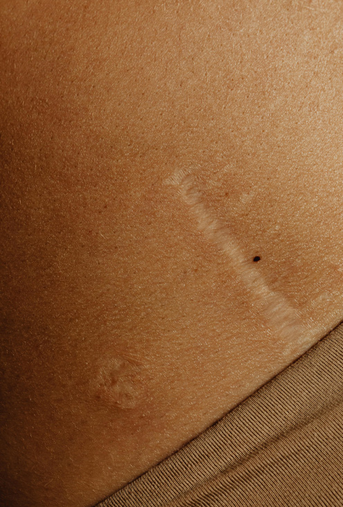 Paul Banwell - Scar Revision Overview